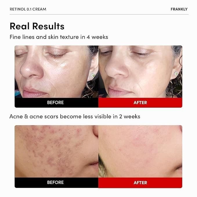 FRANKLY Retinol 0.1% Night Cream Anti-Aging Wrinkle Care – Exp 10/2026 - Thumbnail 2