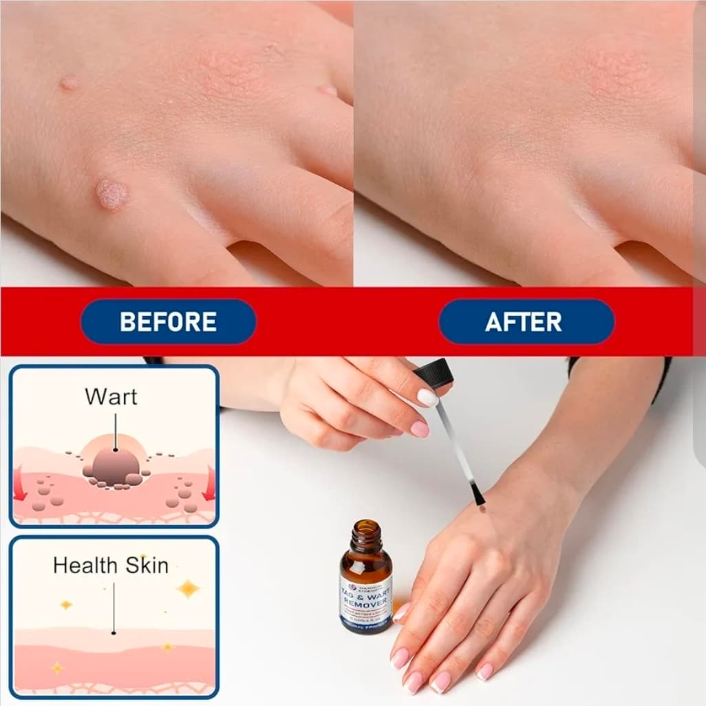 Maximum Strength Tag & Wart Remover Fast Acting Liquid 15ml - Thumbnail 6