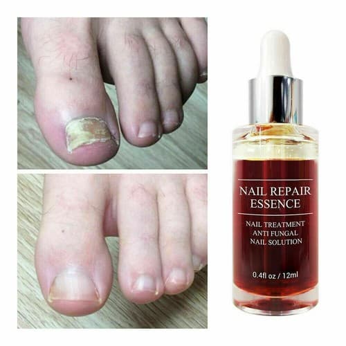Ginger Antibacterial Fungal Nail Treatment Nail Repair Essential Oil Serum 12ml - Thumbnail 3