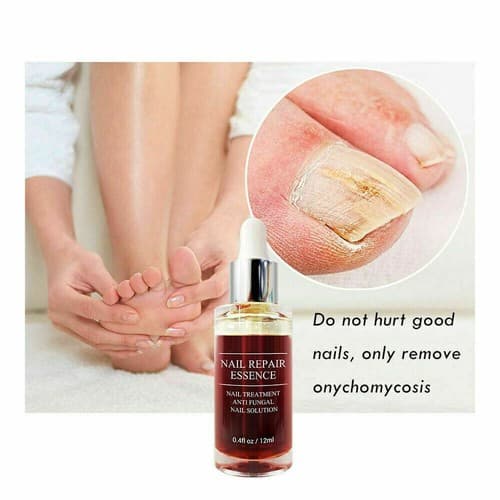 Ginger Antibacterial Fungal Nail Treatment Nail Repair Essential Oil Serum 12ml - Thumbnail 2