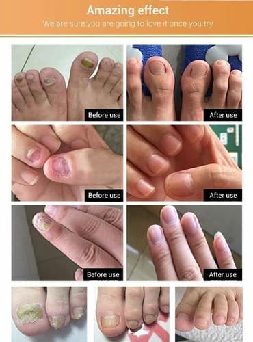 Ginger Antibacterial Fungal Nail Treatment Nail Repair Essential Oil Serum 12ml - Thumbnail 10