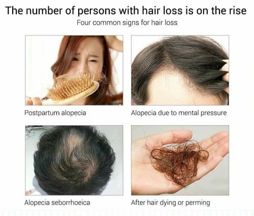 Lanbena Ginger Extract Hair Care Fast Powerful Hair Growth Essential Oil 20ml - Thumbnail 8