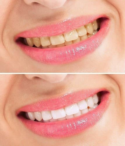 Venicare 10 Pcs Professional Single Speed Up Special 5 LED Teeth Whitening Light - Thumbnail 3