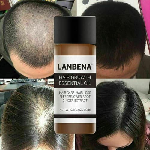 2 Pack Powerful Natural Hair Loss Treatment Fast Hair Growth Essential Oil 20ml - Image 1