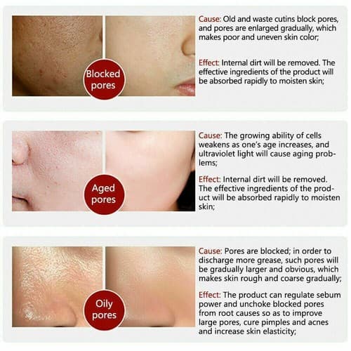 2 pack Pore Shrinkage Remove Blackhead Whitehead Acne Deep Cleansing Whitening - Thumbnail 2
