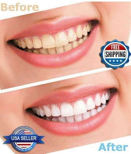 100 Pcs LED Blue White Mouth Teeth Bleaching Whitening Light with Batteries - Thumbnail 7