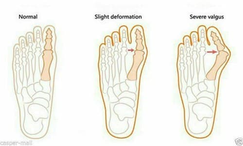 4 Pcs Gel Big Toe Bunion Guards Toe Spreaders Pain Relief Crooked Overlapping - Thumbnail 9