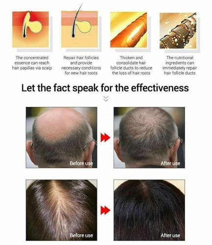 2 Pack Lanbena Natural Hair Loss Treatment Fast Hair Growth Essential Oil 20ml - Thumbnail 7