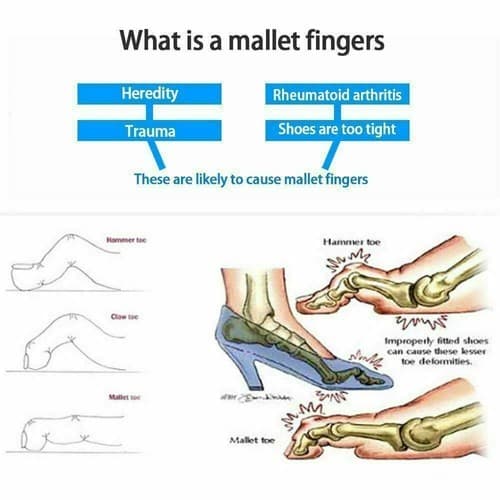 4 Pcs Toe Straightener Aid Pain Relief Hammer Claw Mallet Soft Gel Toe Separator - Thumbnail 3