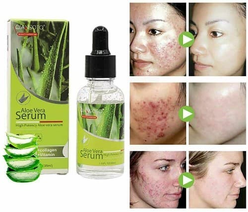 Aloe Vera Facial Serum – Natural Acne Healing & Soothing Skin Repair - Image 1