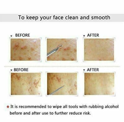 Acne Needle Blackhead Remover Pimple Blemish Comedone Extractor Tool Kit 7 Pcs - Thumbnail 8