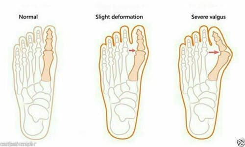 2 Pcs Gel Big Toe Bunion Guards Toe Spreaders Pain Relief Crooked Overlapping - Thumbnail 8