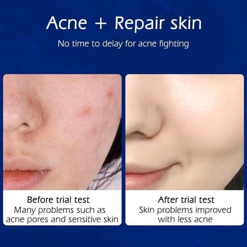 2 Pack Acne Removal Nicotinamide Cream Aloe Vera Oil Control Shrink Pores - Thumbnail 2
