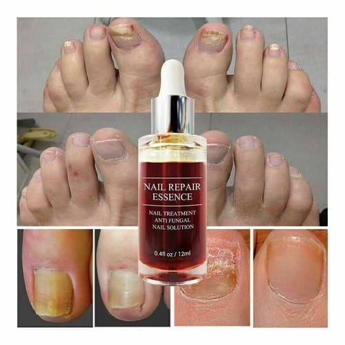 2 Pack Ginger Antibacterial Fungal Nail Treatment Nail Repair Oil Serum 12ml - Thumbnail 4