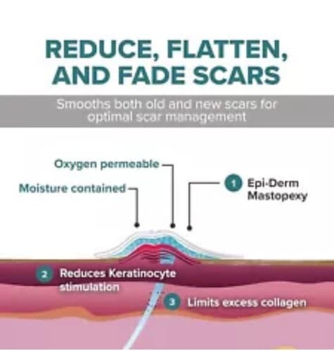 Epi-Derm Silicone Scar Tape - Anchor Design for Breast Reduction Recovery - Thumbnail 4