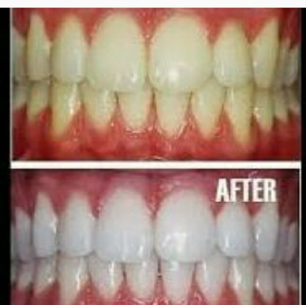 (1) Super White Teeth Pen- in 5 Days!! - Thumbnail 4