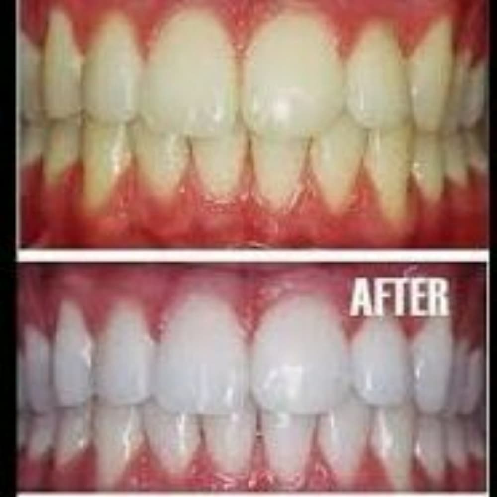 Natural White 5-Minute Teeth Whitening Kit!