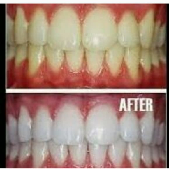 (2) Instant Teeth Whitening Pen - Thumbnail 5