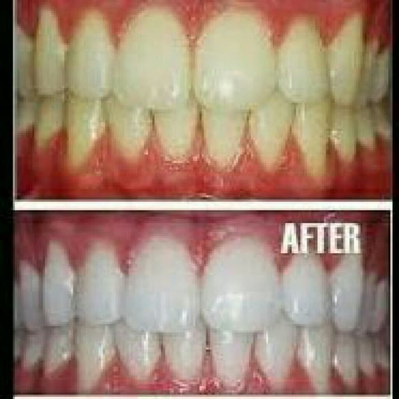 (X3) Instant Teeth Whitening Pens - Thumbnail 2