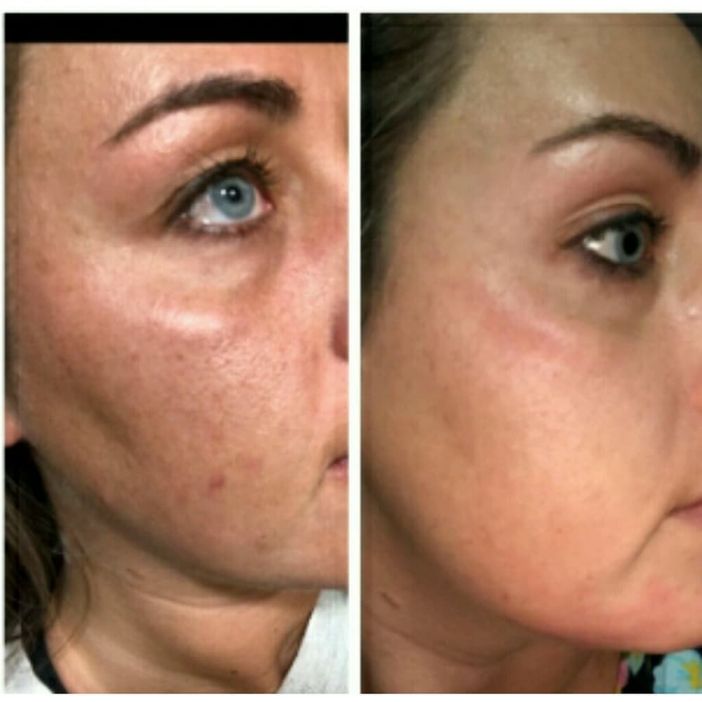 Double Strength Night Serum-Get Clear Skin!! - Thumbnail 6