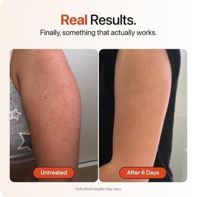 Strawberry KP Bump Eraser Cream Keratosis Pilaris Glycolic Acid Exfoliating - Thumbnail 3