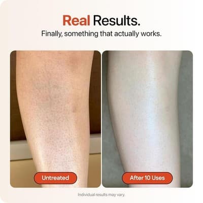 Strawberry KP Bump Eraser Cream Keratosis Pilaris Glycolic Acid Exfoliating - Thumbnail 5