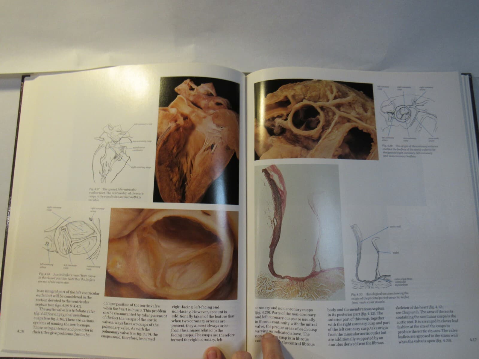 CARDIAC Anatomy: AN INTEGRAL TEXT AND COLOUR ATLAS By Robert H. Anderson Q30J - Thumbnail 6