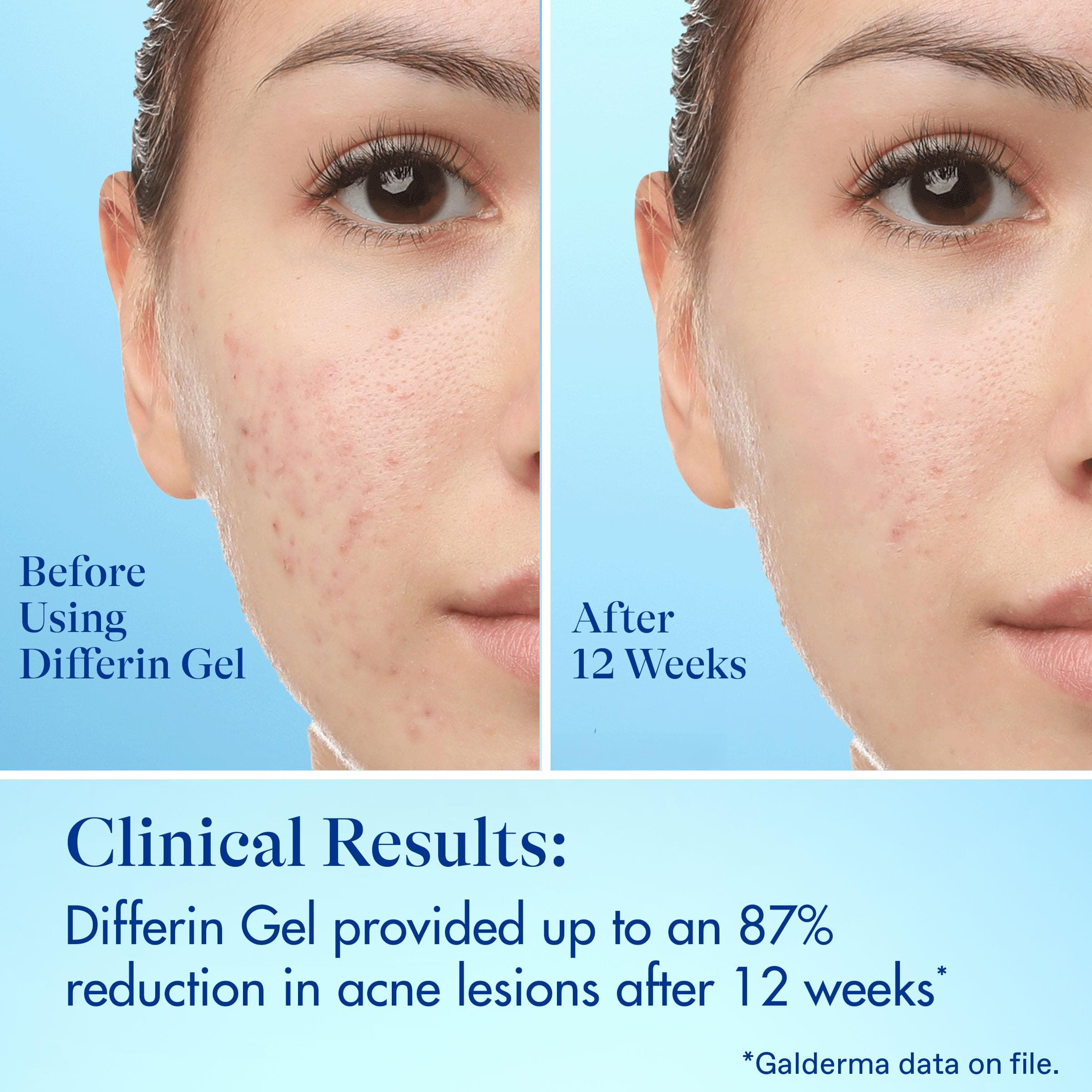 Differin Acne Fighter Pack Salicylic Acid Pimple Patches 36 Count Acne Treatment - Thumbnail 8