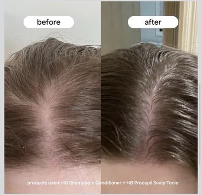 BondiBoost HG Procapil Scalp Tonic – 4.23 fl oz - Thumbnail 3