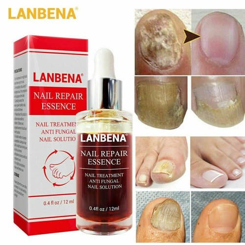 Ginger Antibacterial Fungal Nail Treatment Nail Repair Essential Oil Serum 12ml - Image 1
