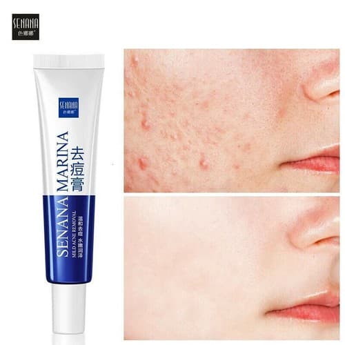 2 Pack Acne Removal Nicotinamide Cream Aloe Vera Oil Control Shrink Pores - Image 1
