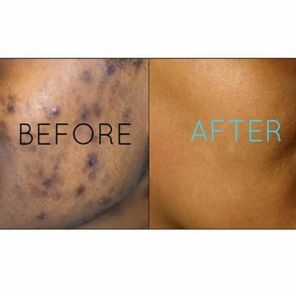 Get Beautiful Skin-Dark Spot Remover